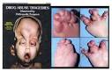 Side Effects Of Drug Abuse