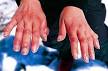 Frostbite - Wikipedia, the free encyclopedia