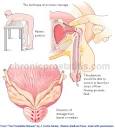 Prostatitis Prostate Massage or Drainage