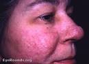 Tuberose (tuberous) <b>sclerosis</b>: