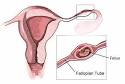 Ectopic Pregnancy or Tubal Pregnancy