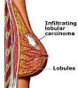 The <b>lobular cancer</b> cells look