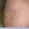 Hot tub <b>folliculitis</b>