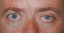 Horner's Syndrome