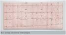 Arquivos Brasileiros de Cardiologia - Case 01/2006: progressive