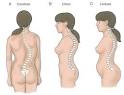 .:: <b>Lordose</b>, Cifose, Escoliose