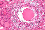 File:<b>Subacute thyroiditis</b>