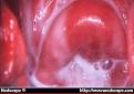 Clinical Trials and Images of Bacterial Vaginosis