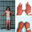 <b>Hypoparathyroidism</b> is
