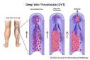 Deep Vein Thrombosis and Pulmonary Embolism Overview - SIR