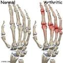 What Causes Arthritis Pain? - Hispanically Speaking News