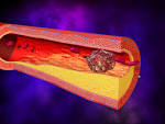 What Is <b>Thrombosis</b>?