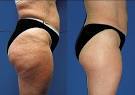 Cellulite Treatment Called “Revolutionary” | The Professional ...