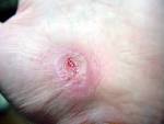 http://upload.wikimedia.org/wikipedia/commons/3/36/Hand_Abrasion_-_17_days_11_hours_30_minutes_after_injury.JPG