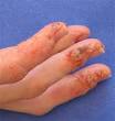 Late stage of <b>dyshidrosis</b> on