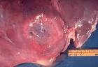 <b>amoebic liver abscess</b> [23]