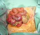 <b>perforación intestinal</b> con