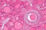 File:<b>Subacute thyroiditis</b>