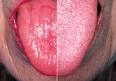with <b>Sjögren's syndrome</b>,