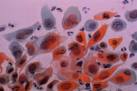 Frotis de <b>neoplasia</b>