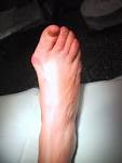 File:<b>Hallux</b> Valgus-Aspect pré