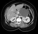 Pancreatic <b>mucinous</b> cystadenoma | Image | Radiopaedia.