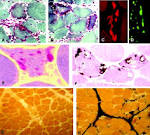 Inclusion-body myositis
