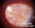 EyeRounds.org: <b>Serratia</b> Marcescens seton implant <b>infection</b>
