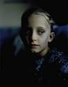 Crigler-Najjar Syndrome