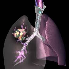 How to Keep Your Lungs Healthy by Recognizing & Preventing Lung Cancer
