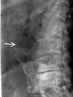 Aortic Aneurysm Thoracic Aortic Aneurysm Spine Doctor Colorado