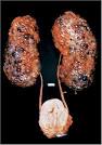 INSUFICIÊNCIA <b>RENAL</b> CRÔNICA