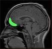 Impulsivity - Wikipedia, the free encyclopedia
