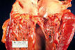 Infective endocarditis - Wikipedia, the free encyclopedia