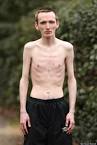 Marc Corn, Anorexic Man Can Only Eat Chocolate Mousse And Custard ...