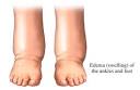 <b>Edema</b> forms when fluid gets