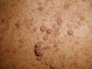 <b>Neurofibroma</b>