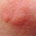 Mosquito Bites – Pictures, Itch, Swelling, Prevention and Treatment