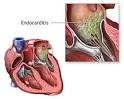 Endocarditis - Medicalook