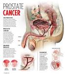 prostate-cancer-symptoms ��� Secrets of the Fed