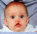MayoClinic.com Health Library - Cleft lip and cleft palate