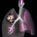 Lung Cancer