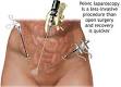 <b>Laparoscopy</b> can be performed
