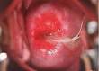 Vaginal Discharge
