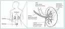 What causes <b>nephrotic syndrome</b>