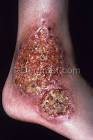 <b>Pyoderma Gangrenosum</b> Photo