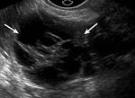 <b>Ovarian</b> epithelial cancer in a