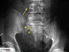 Malgaigne Fracture: Vertical Shear - Wheeless' Textbook of ...
