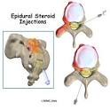 A Patient's Guide to Pain Management: Epidural Steroid Injections<
