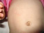 Roseola